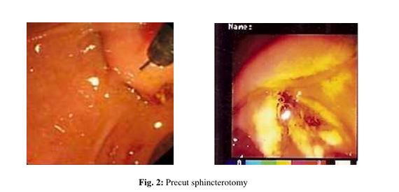Needle knief precut sphincterotomy versus standard sphincterotomy in post ERCP pancreatitis.